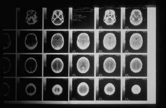 Photo Brain scan